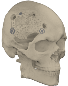 Cranial reconstruction with patient-specific cranial plate