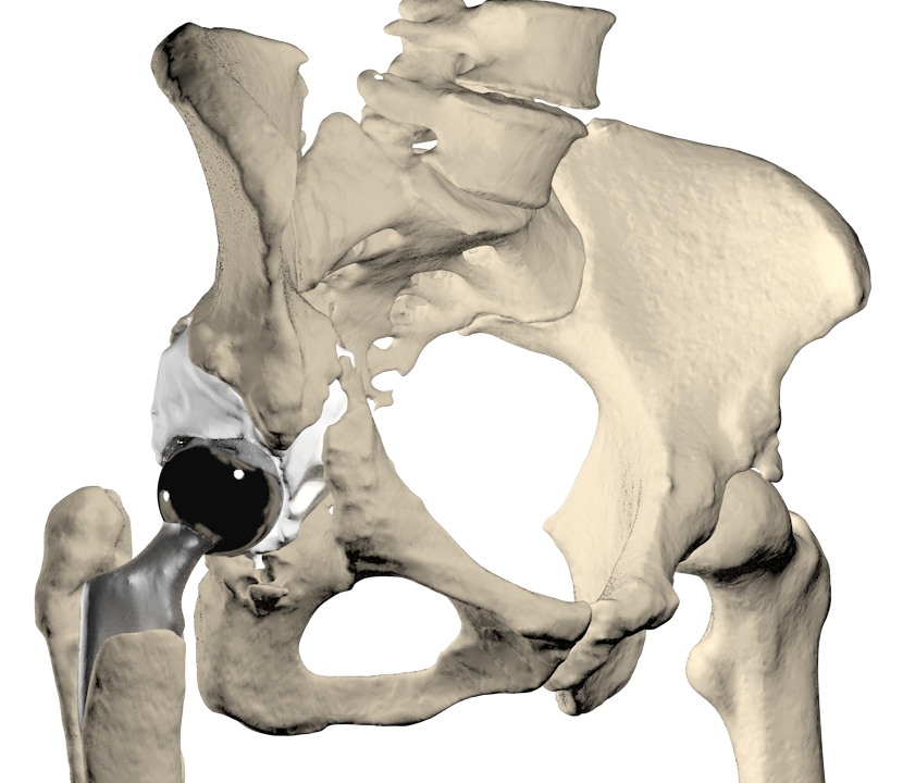 Операция тазобедренный кость