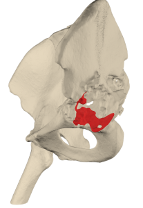 Reconstruction of acetabulum with titanium augment during hip arthroplasty