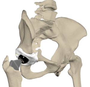 First-stage revision hip endoprosthesis with patient-specific acetabular cup spacer