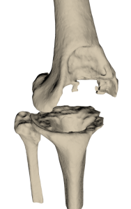 First-stage revision knee endoprosthesis with patient-specific tibial spacer