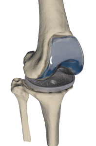 Первый этап ревизионного эндопротезирования индивидуальным тибиальным спейсером коленного сустава
