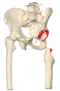 First-stage revision hip endoprosthesis with patient-specific proximal hip spacer