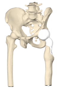 First-stage revision hip endoprosthesis with patient-specific proximal hip spacer