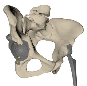 Revision hip endoprosthesis with patient-specific acetabular cup
