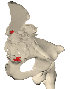 Revision hip endoprosthesis with patient-specific acetabular cup