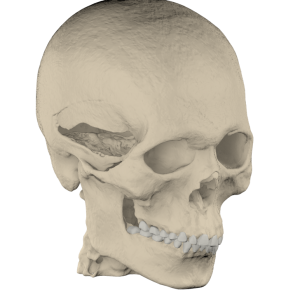 Reconstruction of cranial defect with patient-specific cranial plate