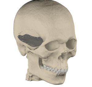 Reconstruction of cranial defect with patient-specific cranial plate