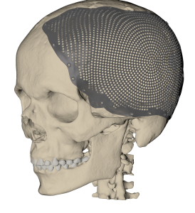 Reconstruction of large cranial defect with patient-specific cranial plate