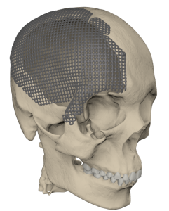 Ревизионное эндопротезирование черепа двумя индивидуальными краниальными пластинами 