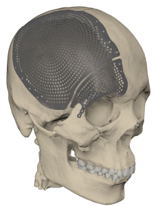 Ревизионное эндопротезирование черепа двумя индивидуальными краниальными пластинами 