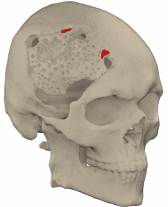 Восстановление черепа индивидуальной краниальной пластиной