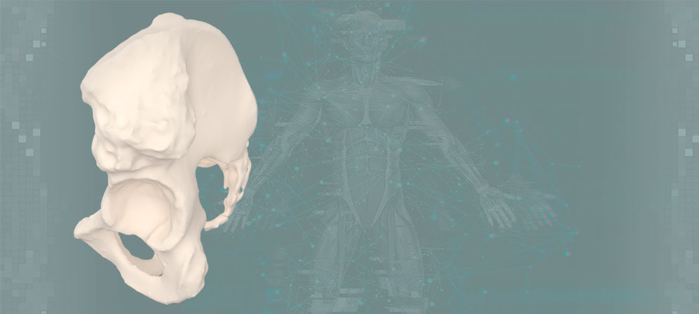 Anatomical pelvis model with iliac bone defect