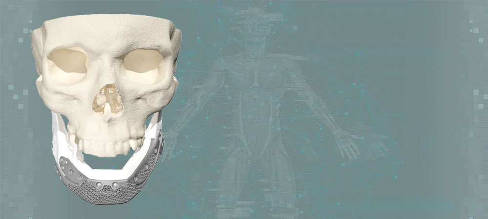 Lower jaw implant for bone grafting