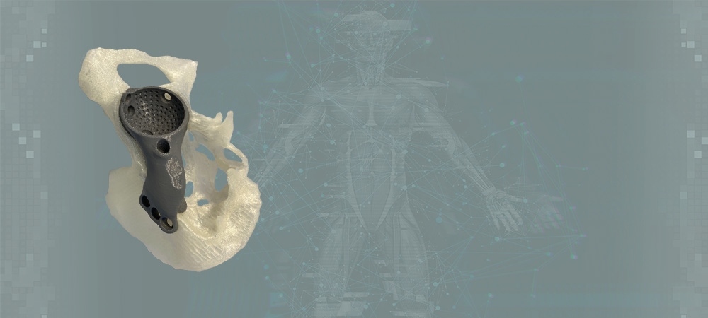 Анатомическая модель подвздошной кости с примерочной моделью ацетабулярного компонента 