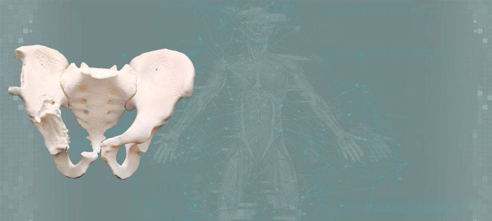 Анатомическая модель таза пациента с дефектами подвздошной кости, вертлужной впадины и резецированной частью лонного сочленения